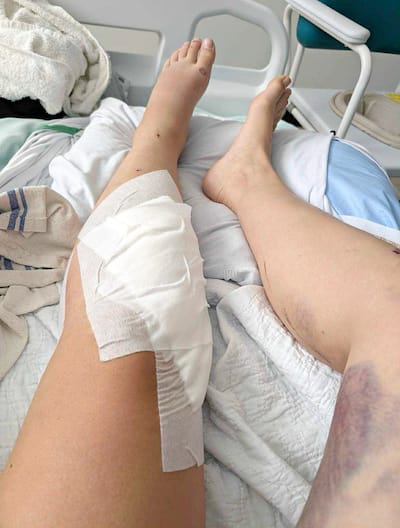Stéphanie Lamarre a subit des blessures au bas du corps. Plusieurs points de suture ont été effectués sur sa jambe gauche.